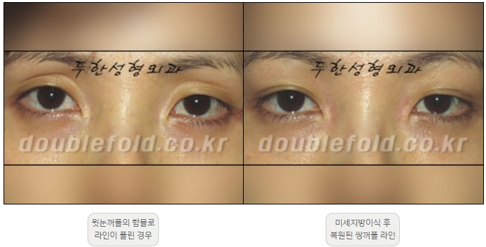 [두한성형외과 쌍커풀재수술] - [풀린 쌍커풀라인 교정] 관련 이미지 17
