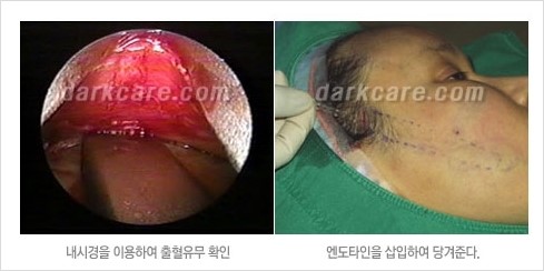 [두한성형외과 경쟁력 주름성형] - [주름제거를 위한 리프팅] 관련 이미지 21