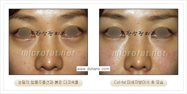 [두한성형외과 경쟁력 눈밑성형] - [눈밑 다크써클 치료에 대한 자주하는 질문과 답변 모음 안내] 관련 이미지 17