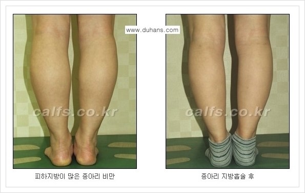 [두한성형외과 경쟁력 멀티종아리성형] - [예쁜 종아리를 만드는 종아리 지방흡입술 안내] 관련 이미지 10