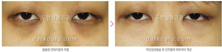 두한성형외과 눈밑수술 - 다크서클 수술 전후 관리 안내 관련 이미지 81