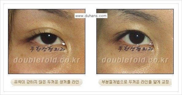 [두한성형외과 경쟁력 눈성형] - [부분절개법으로 두껍고 어색한 라인 교정 안내 2.] 관련 이미지 1