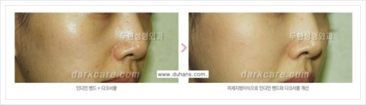 [두한성형외과  경쟁력 다크써클 교정] - [다크써클 + 인디언밴드 교정 안내] 관련 이미지 4