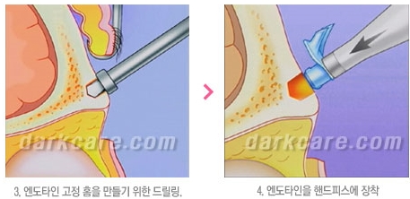 Duhan Plastic Surgery Combo Program - Dark Circles and Lifting image 29