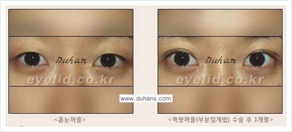 [언론속의 두한성형외과] - [▶ 티 나지 않는 쌍꺼풀수술이 진짜다? ◀] 관련 이미지 3