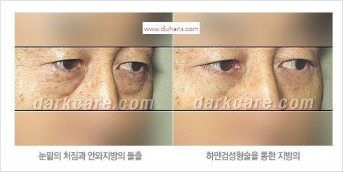 [두한성형외과 경쟁력 눈밑성형] - [눈밑 안와지방 돌출의 무통마취 무흉터 눈밑지방제거 안내] 관련 이미지 9
