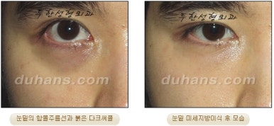 두한성형외과 눈밑성형 - 눈밑지방제거, 눈밑주름, 눈밑지방재배치 관련 이미지 92