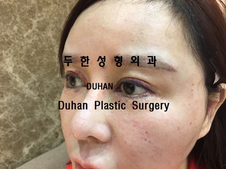 #쌍꺼풀재수술 지방전진 #재배치 를 통해 라인 자연스럽게 낮추기, #눈재수술 #인라인 관련 이미지 5