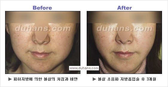 [두한성형외과 경쟁력 얼굴지방흡입] - [통통한 볼살, 두툼한 턱살(턱선)의 지방흡입] 관련 이미지 12