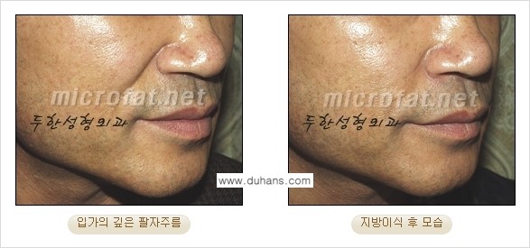 [두한성형외과 경쟁력 미세지방이식] - [입가주름, 팔자주름 미세지방이식 안내 ②] 관련 이미지 4