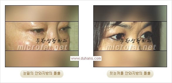[두한성형외과 경쟁력 지방제거] - [눈 지방제거 안내] 관련 이미지 1