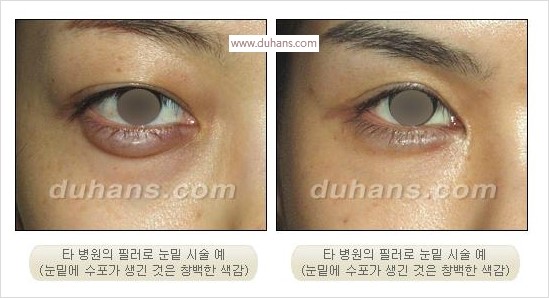 [두한성형외과 경쟁력 눈밑성형] - [Dr. 컬럼 필러 시술의 부작용에 대한 우려] 관련 이미지 3