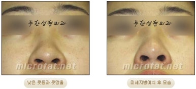 [Duhan Plastic Surgery Facial Fat Grafting] - [Fat Grafting Rhinoplasty] image 9