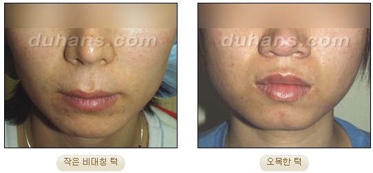 [Duhan Plastic Surgery Micro Fat Grafting] - [Receded Chin, Small Chin, Cleft Chin, Chin Line Asymmetry Correction] image 1