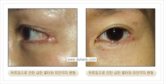 ​[두한성형외과 경쟁력 눈매성형] - [눈의 가로길이를 키우는 앞트임, 뒤트임 수술] 관련 이미지 28
