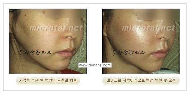 [두한성형외과 경쟁력 윤곽성형] - [볼, 볼살 지방이식] 관련 이미지 33