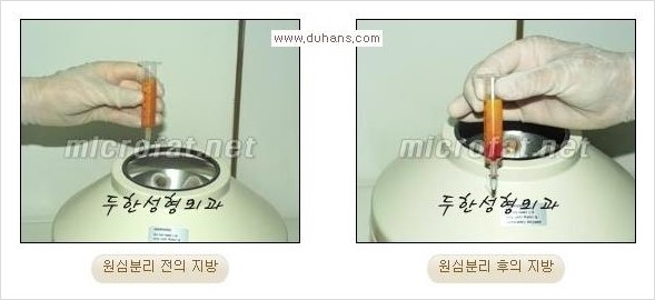 [두한성형외과 경쟁력 미세지방이식] - [관자놀이(측두부) 지방이식] 관련 이미지 3