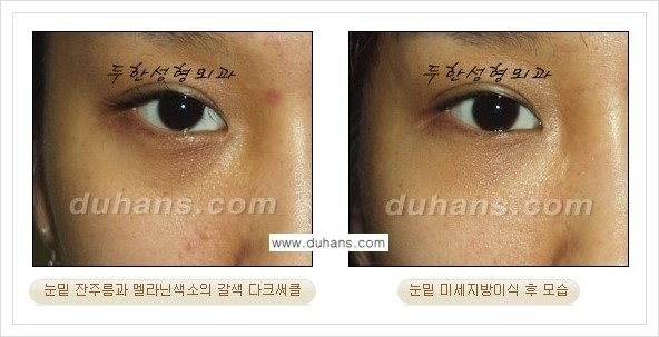 [두한성형외과 경쟁력 눈밑성형] - [꺼진 눈밑, 눈밑 함몰 주름선 눈밑 미세지방이식 안내] 관련 이미지 10