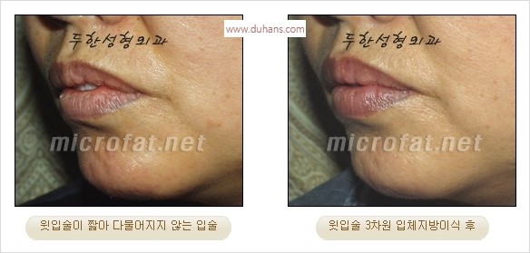​​[두한성형외과 경쟁력 미세지방이식] - [볼륨감 있는 입술성형] 관련 이미지 8