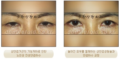 [Duhan Plastic Surgery Double Eyelid Surgery] - [Ptosis Correction Revision Surgery] image 11