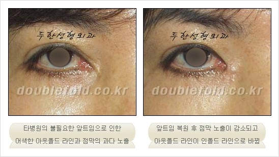 ⁠⁠[두한성형외과 경쟁력 쌍꺼풀 재수술] - [재수술 대상과 재수술의 문제점] 관련 이미지 37