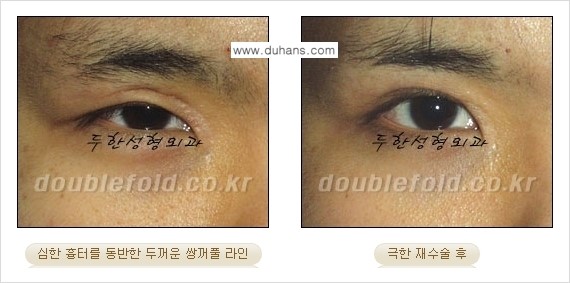[두한성형외과 경쟁력 쌍꺼풀 재수술, 극한 눈재수술] - [망친 쌍꺼풀을 복원하는 극한 눈재수술] 관련 이미지 13