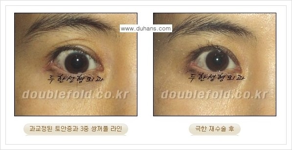 [두한성형외과 경쟁력 쌍꺼풀 재수술, 극한 눈재수술] - [쌍꺼풀 재수술, 극한 눈재수술 관련 자주하는 질문과 답변] 관련 이미지 8