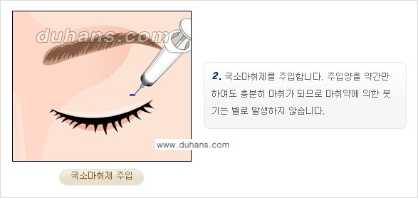 [두한성형외과 경쟁력 지방제거, 지방재배치] - [상큼하고 젊은 눈매 만들기 안내] 관련 이미지 4