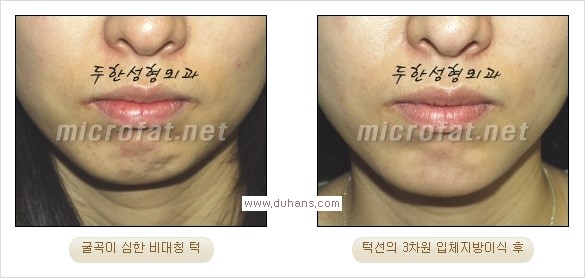 ⁠⁠[두한성형외과 경쟁력 미세지방이식] - [턱 미세지방이식 - 안면윤곽 교정 안내] 관련 이미지 20