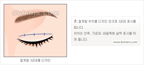 ​[두한성형외과 경쟁력 눈성형] - [자연스럽고 아름다운 쌍꺼풀의 기준] 관련 이미지 8