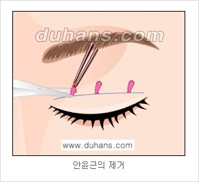 ​[두한성형외과 경쟁력 눈성형] - [자연스러운면서 매력적인 쌍꺼풀 퀵 쌍꺼풀 수술 안내] 관련 이미지 8