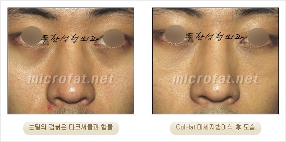 ​[두한성형외과 경쟁력 눈밑성형 리더] - [눈밑 다크써클의 증상, 원인, 종류, 치료방법 안내] 관련 이미지 45