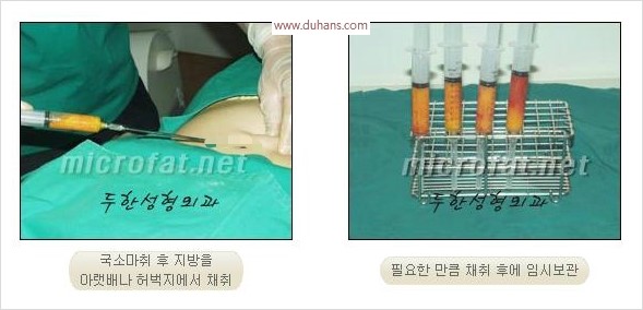 [두한성형외과 경쟁력 코성형 리더] - [자연스럽고 오똑한 콧망울! 코성형 방법]​ 관련 이미지 41