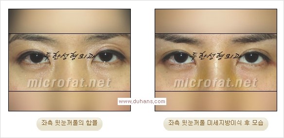 [두한성형외과 Dr. 컬럼] - [눈꺼풀의 지방이식] 관련 이미지 14