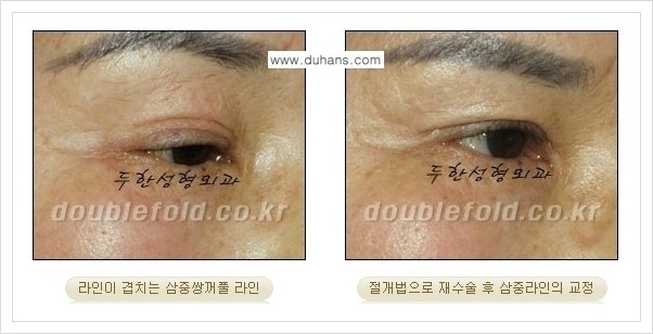 [두한성형외과 경쟁력 쌍꺼풀 재수술, 극한 재수술] - [삼중(세겹) 쌍꺼풀 라인의 교정 안내] 관련 이미지 8