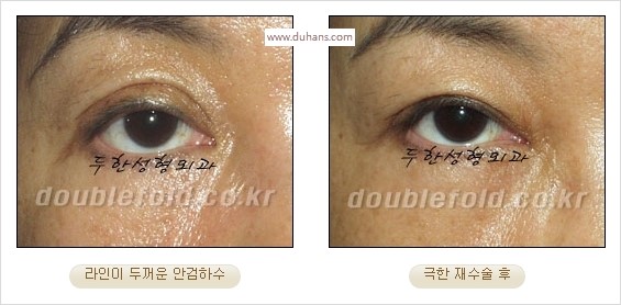 [두한성형외과 경쟁력 쌍꺼풀 재수술 스페셜] - [망가진 라인을 교정하는 극한 재수술] 관련 이미지 10