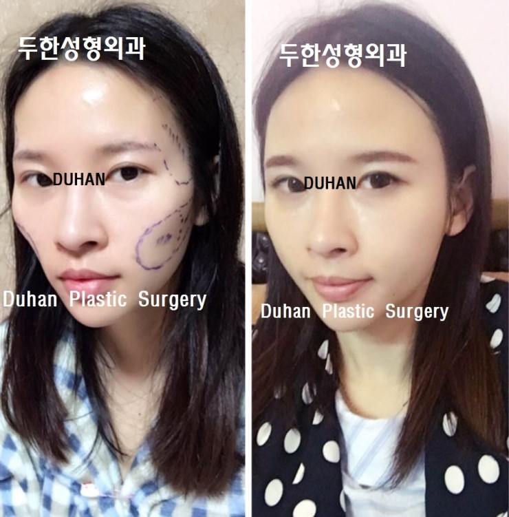 두한성형외과 지방이식 #윤곽성형 #지방이식 #지방이식유명한곳 #지방이식잘하는곳 #이마지방이식 #관자놀이지방이식 #볼지방이식 #풀페이스 관련 이미지 1