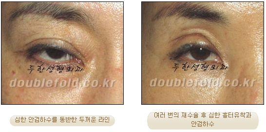 [두한성형외과 쌍수재수술] - [눈재수술에 대한 최선에 대안] 관련 이미지 32