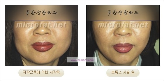 [두한성형외과 경쟁력 안면윤곽성형] - [보톡스(보툴리눔톡신)에 의한 사각턱 교정] 관련 이미지 3
