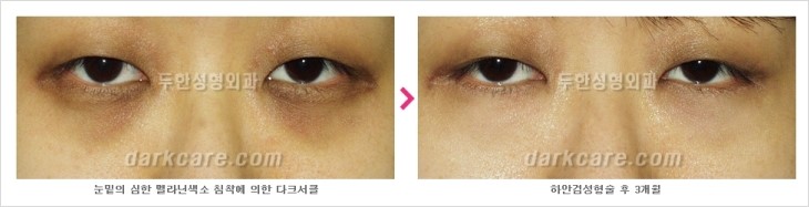 두한성형외과 눈밑수술 - 다크서클 수술 전후 관리 안내 관련 이미지 92