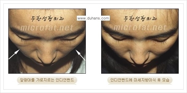 [두한성형외과 경쟁력 미세지방이식] - [귀족수술과 인디언밴드 교정 안내] 관련 이미지 9