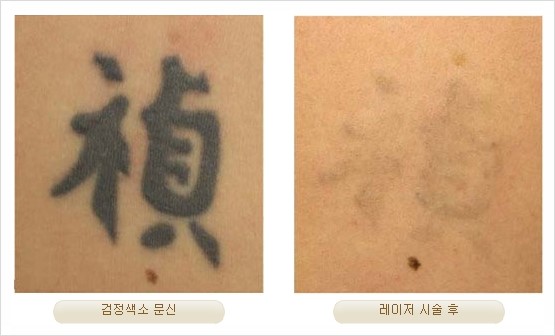 [두한성형외과 경쟁력 안전성형] - [최첨단 장비를 이용한 흉터, 점, 주근깨, 잡티, 문신제거 레이저 시술] 관련 이미지 26