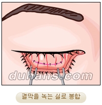 두한성형외과 지방제거 - 눈밑지방, 눈꺼풀지방제거 관련 이미지 18