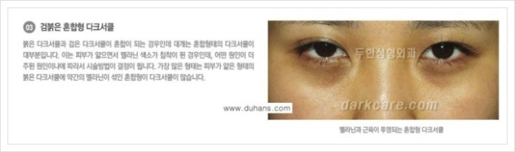 [두한성형외과 경쟁력 눈밑성형] - [다크써클의 종류] 관련 이미지 9