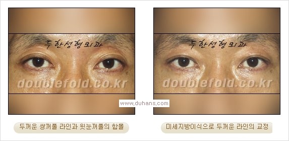 ​⁠⁠[두한성형외과 경쟁력 쌍꺼풀 재수술, 극한 눈재수술] - [지방이식으로 눈매와 쌍꺼풀 라인을 교정] 관련 이미지 7
