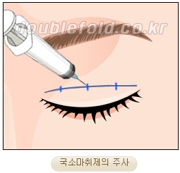 두한성형외과 쌍커풀재수술 - 삼중 쌍커풀 라인 교정 관련 이미지 7
