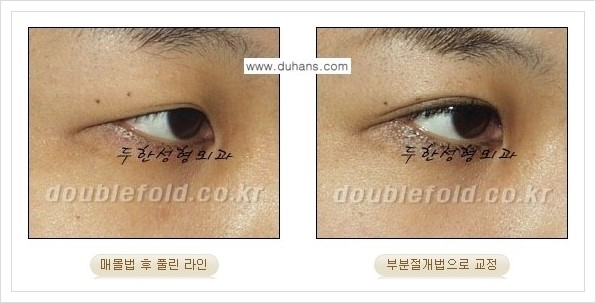 [두한성형외과 경쟁력 쌍꺼풀 재수술, 극한 눈재수술] - [풀린 쌍꺼풀 라인 교정수술 안내] 관련 이미지 8