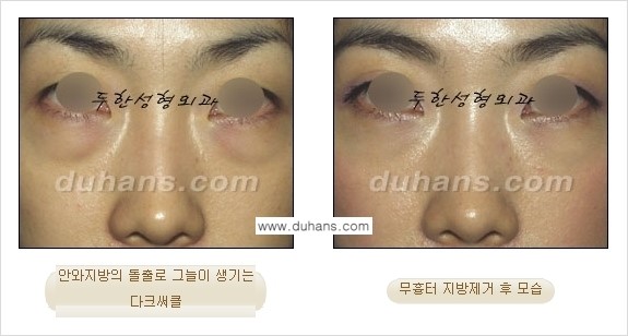 [두한성형외과 젊은 눈매 안검성형] - [눈밑 지방제거의 수술 전후 안내 ①] 관련 이미지 6