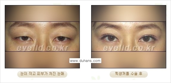 ​[두한성형외과 경쟁력 눈성형] - [자연스러운면서 매력적인 쌍꺼풀 퀵 쌍꺼풀 수술 안내] 관련 이미지 24