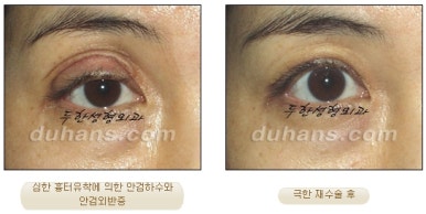 [Special Double Eyelid Revision Surgery at Duhan Plastic Surgery] - [Restorative Surgery for Damaged Double Eyelid Eye Shape] image 8
